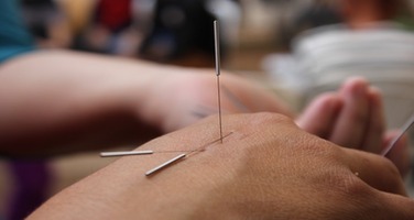 Can Acupuncture Help With Tennis Elbow